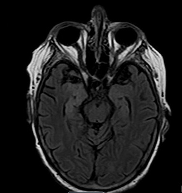 Axial FLAIR MRI of right temporal lobe herpes encephalitis